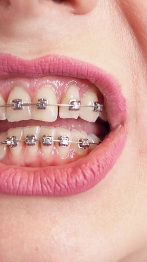 ASMR video: hot BRACES and double layer of medical nurse nitrile gloves (Arya Grander)   Clip 1